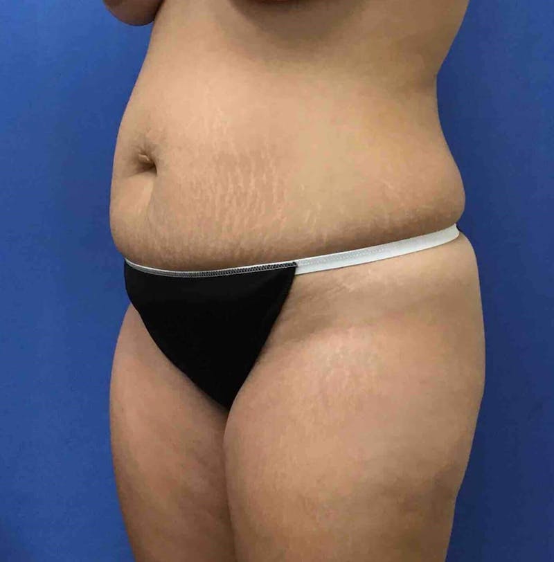 Tummy Tuck Before & After Gallery - Patient 89988305 - Image 7
