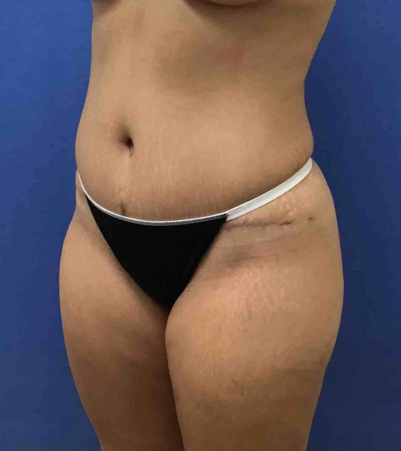 Tummy Tuck Before & After Gallery - Patient 89988305 - Image 8