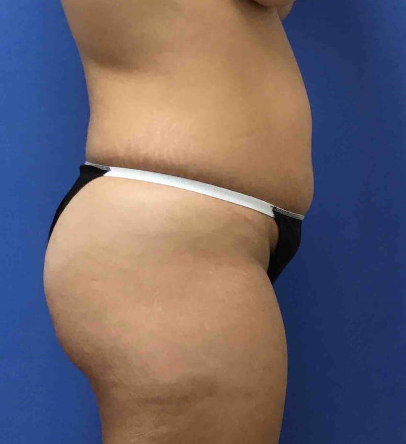 Tummy Tuck Before & After Gallery - Patient 89988305 - Image 9