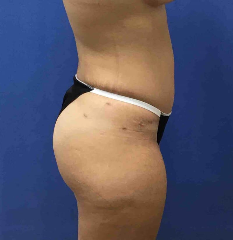 Tummy Tuck Before & After Gallery - Patient 89988305 - Image 10