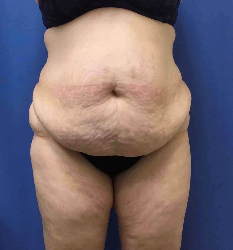 Tummy Tuck Before & After Gallery - Patient 89988309 - Image 1