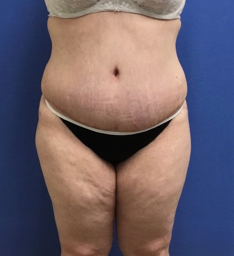 Tummy Tuck Before & After Gallery - Patient 89988309 - Image 2