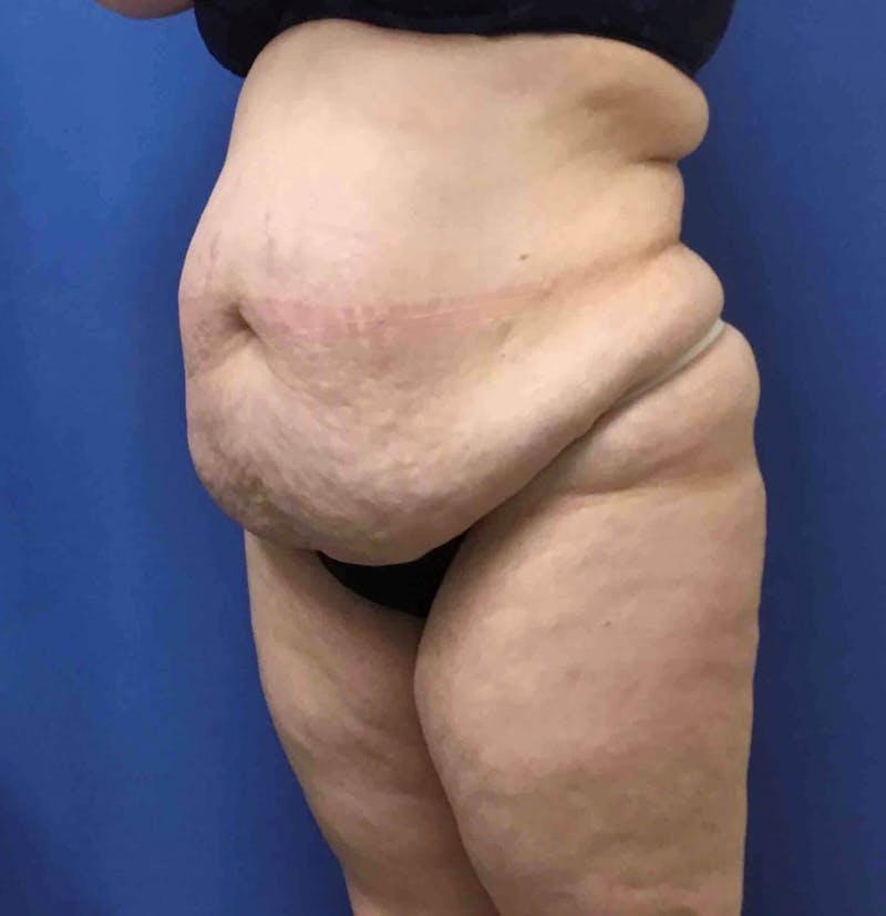 Tummy Tuck Before & After Gallery - Patient 89988309 - Image 3