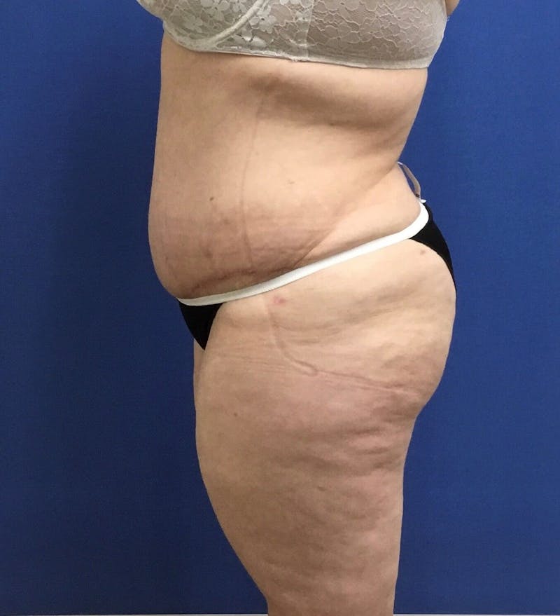 Tummy Tuck Before & After Gallery - Patient 89988309 - Image 6