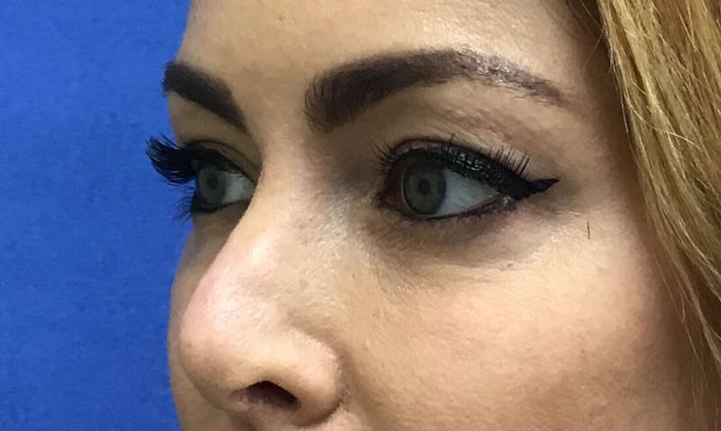 Eyelid Surgery Before & After Gallery - Patient 89989076 - Image 3