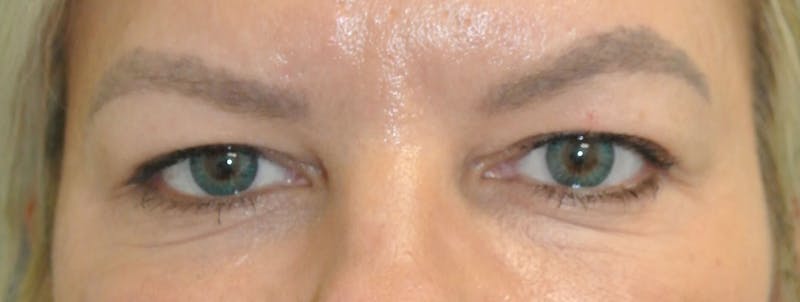 Eyelid Surgery Before & After Gallery - Patient 89989080 - Image 1
