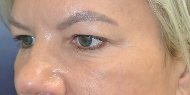 Eyelid Surgery Before & After Gallery - Patient 89989080 - Image 3