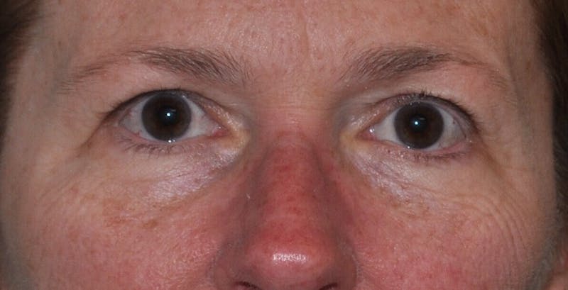 Eyelid Surgery Before & After Gallery - Patient 89989081 - Image 1