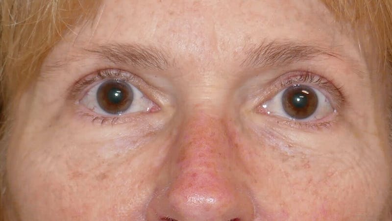 Eyelid Surgery Before & After Gallery - Patient 89989081 - Image 2