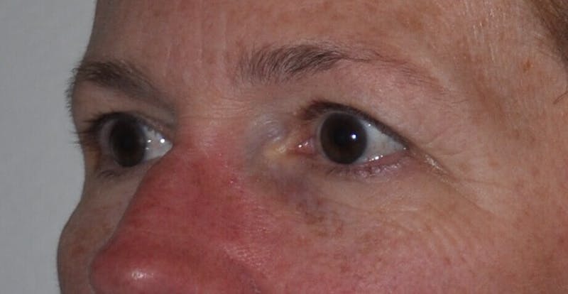 Eyelid Surgery Before & After Gallery - Patient 89989081 - Image 3