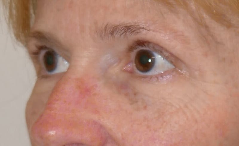 Eyelid Surgery Before & After Gallery - Patient 89989081 - Image 4