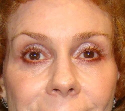 Eyelid Surgery Gallery - Patient 89989172 - Image 2
