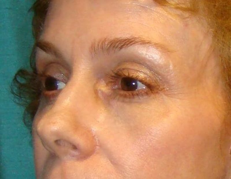 Eyelid Surgery Before & After Gallery - Patient 89989172 - Image 3