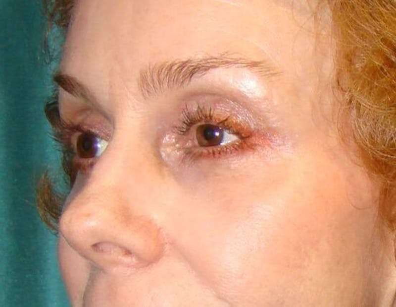 Eyelid Surgery Before & After Gallery - Patient 89989172 - Image 4