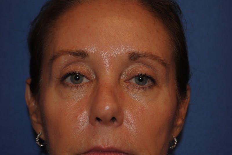 Eyelid Surgery Before & After Gallery - Patient 89989295 - Image 3