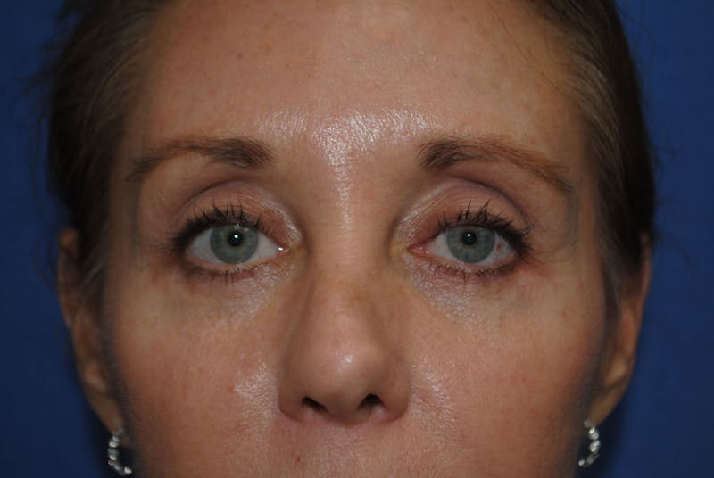 Eyelid Surgery Before & After Gallery - Patient 89989295 - Image 4