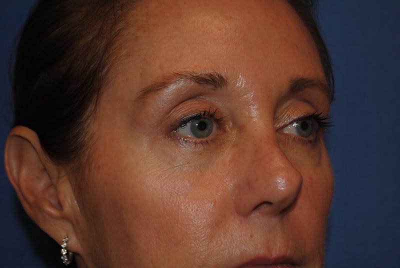 Eyelid Surgery Before & After Gallery - Patient 89989295 - Image 7