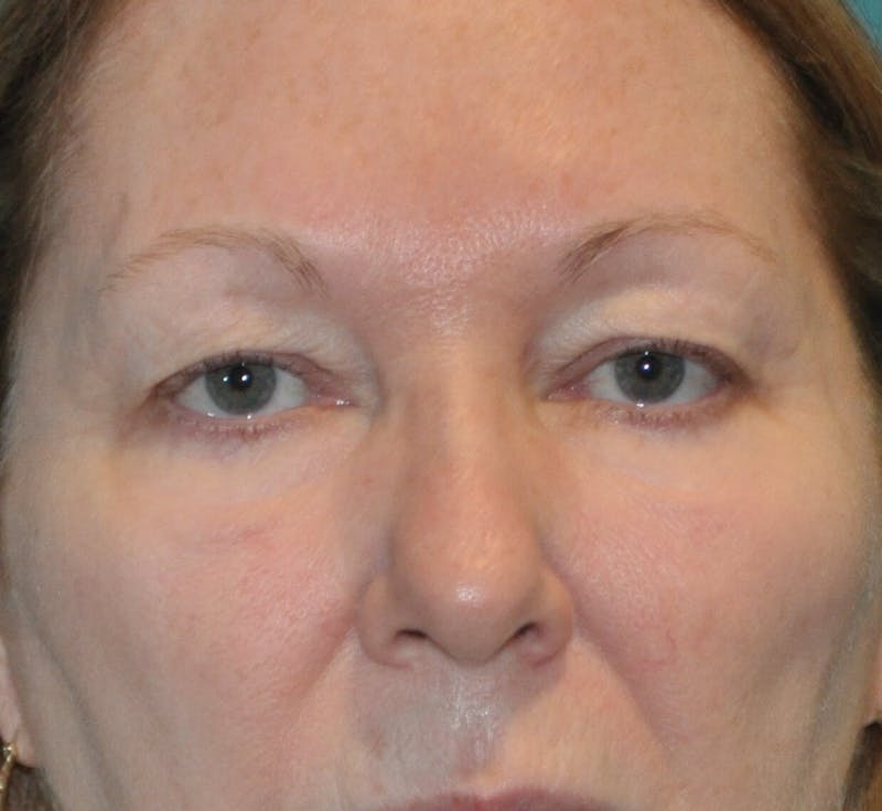 Eyelid Surgery Before & After Gallery - Patient 89990632 - Image 1