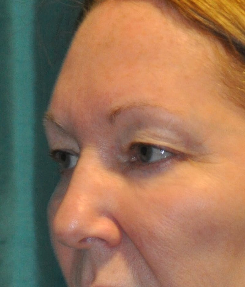 Eyelid Surgery Before & After Gallery - Patient 89990632 - Image 3