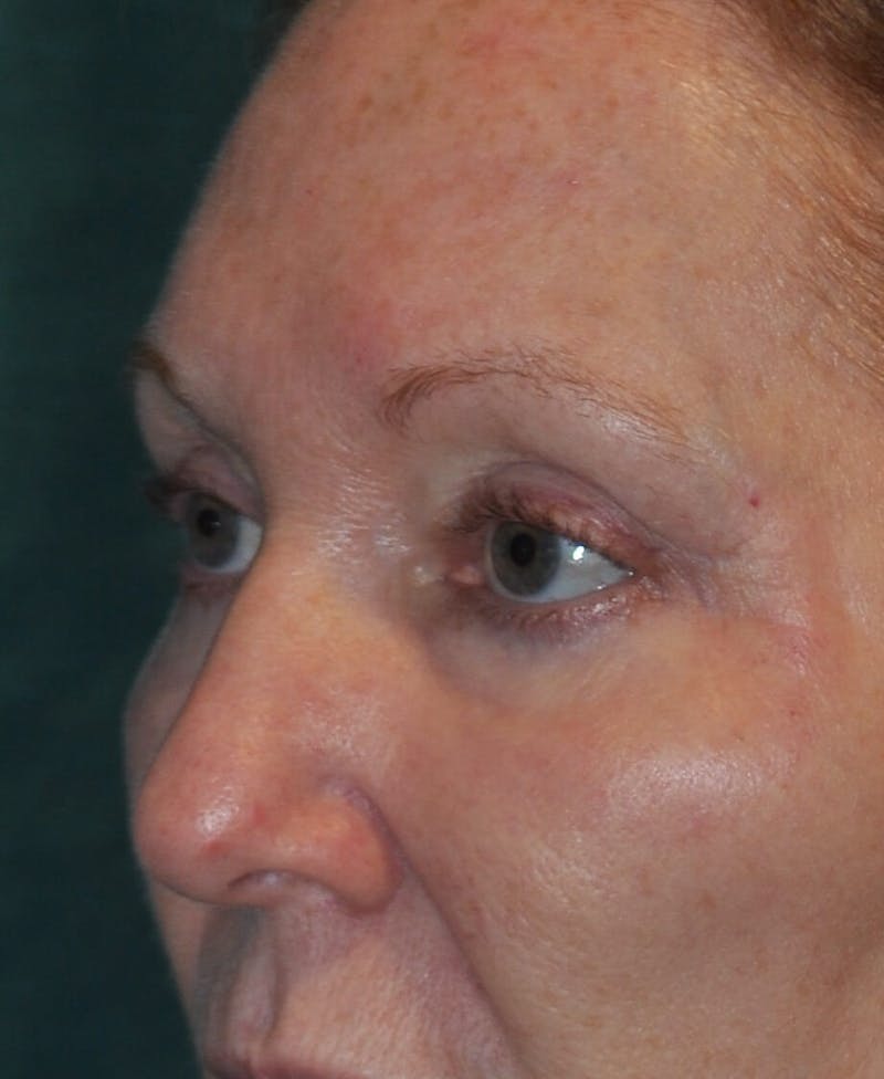 Eyelid Surgery Before & After Gallery - Patient 89990632 - Image 4