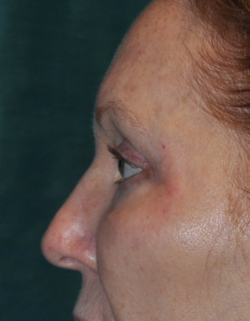 Eyelid Surgery Before & After Gallery - Patient 89990632 - Image 6
