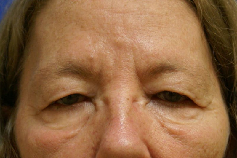 Eyelid Surgery Before & After Gallery - Patient 89990714 - Image 1