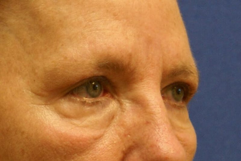 Eyelid Surgery Before & After Gallery - Patient 89990714 - Image 4