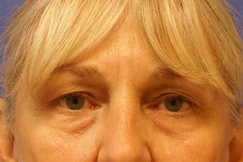 Eyelid Surgery Before & After Gallery - Patient 89990727 - Image 1
