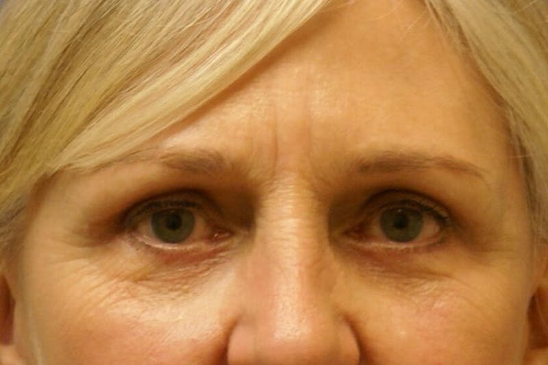 Eyelid Surgery Before & After Gallery - Patient 89990727 - Image 2