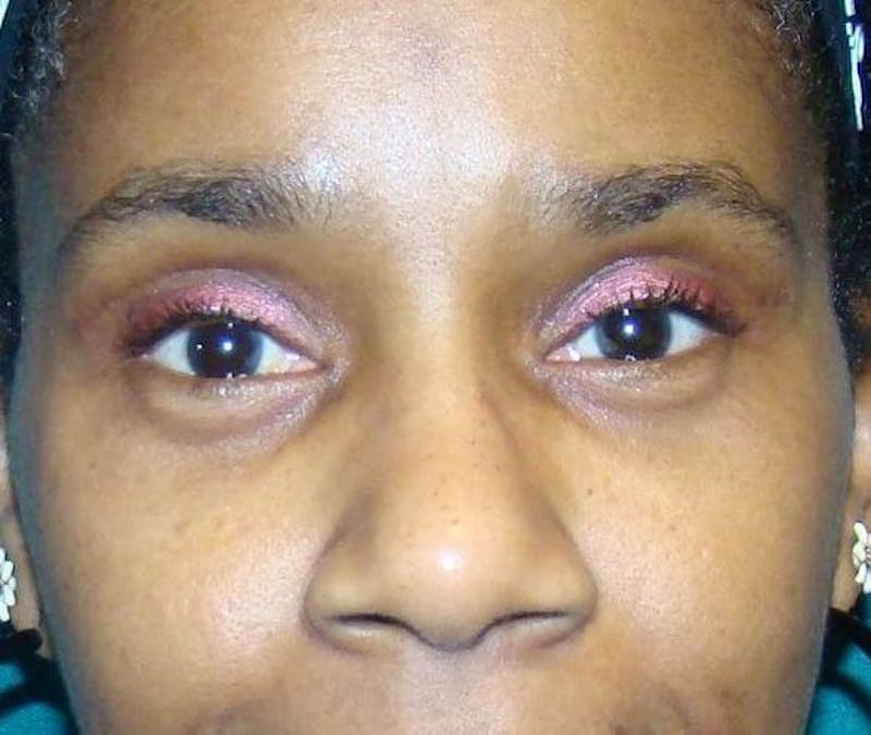 Eyelid Surgery Before & After Gallery - Patient 89990737 - Image 2