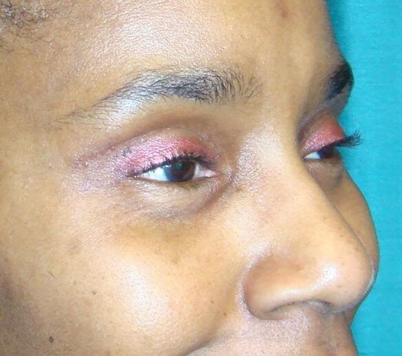 Eyelid Surgery Before & After Gallery - Patient 89990737 - Image 4