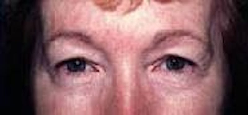 Eyelid Surgery Before & After Gallery - Patient 89990758 - Image 1