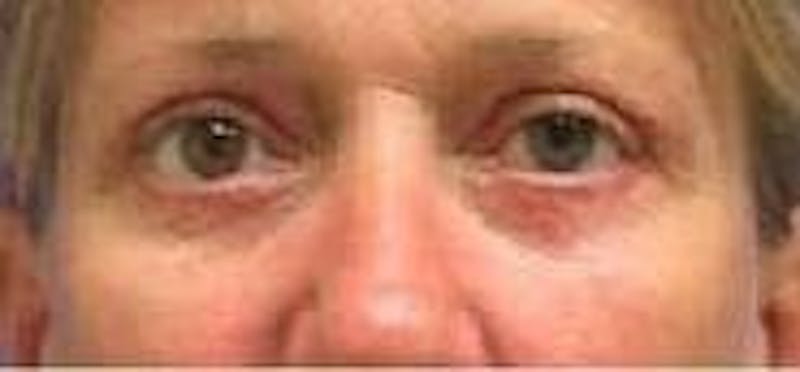 Eyelid Surgery Before & After Gallery - Patient 89990889 - Image 2