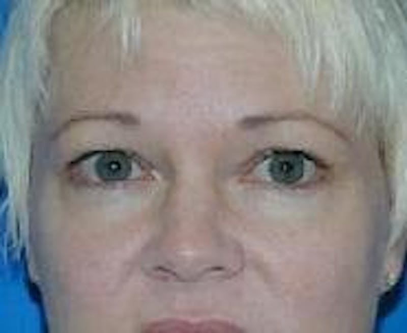 Eyelid Surgery Before & After Gallery - Patient 89990934 - Image 3