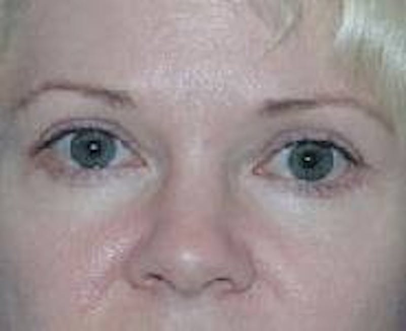 Eyelid Surgery Before & After Gallery - Patient 89990934 - Image 4