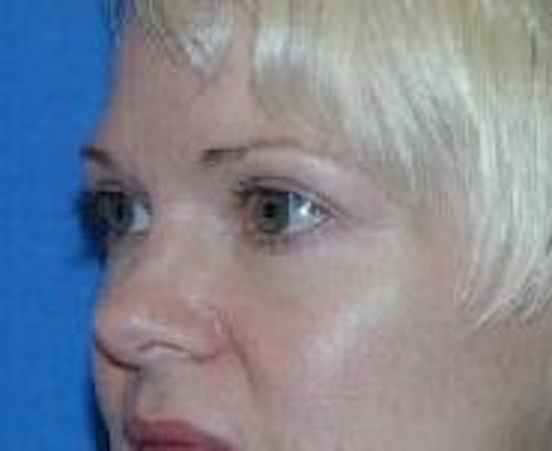 Eyelid Surgery Before & After Gallery - Patient 89990934 - Image 6