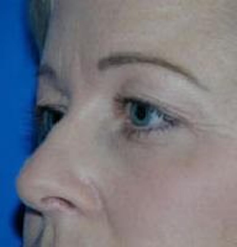 Eyelid Surgery Before & After Gallery - Patient 89990950 - Image 1