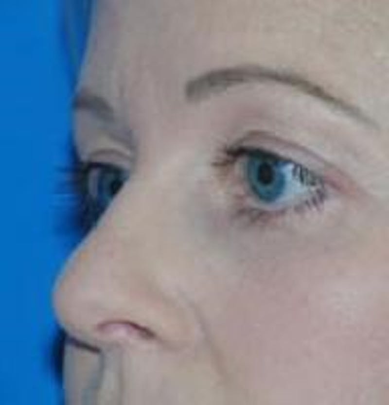 Eyelid Surgery Before & After Gallery - Patient 89990950 - Image 2