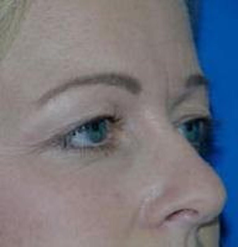 Eyelid Surgery Before & After Gallery - Patient 89990950 - Image 3