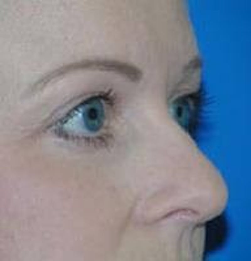 Eyelid Surgery Before & After Gallery - Patient 89990950 - Image 4