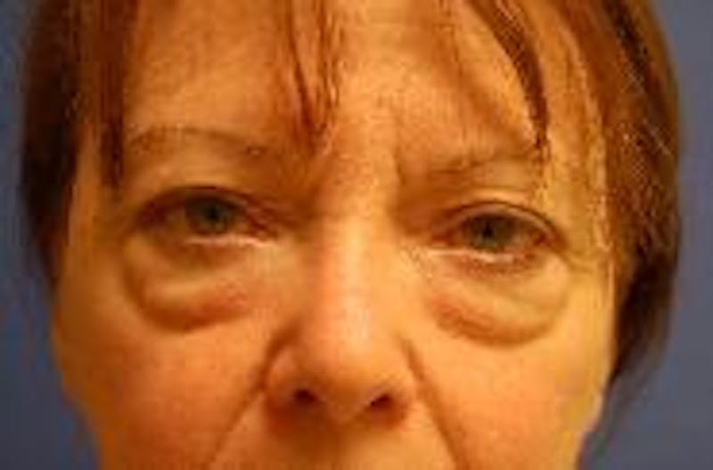 Eyelid Surgery Before & After Gallery - Patient 89990963 - Image 1