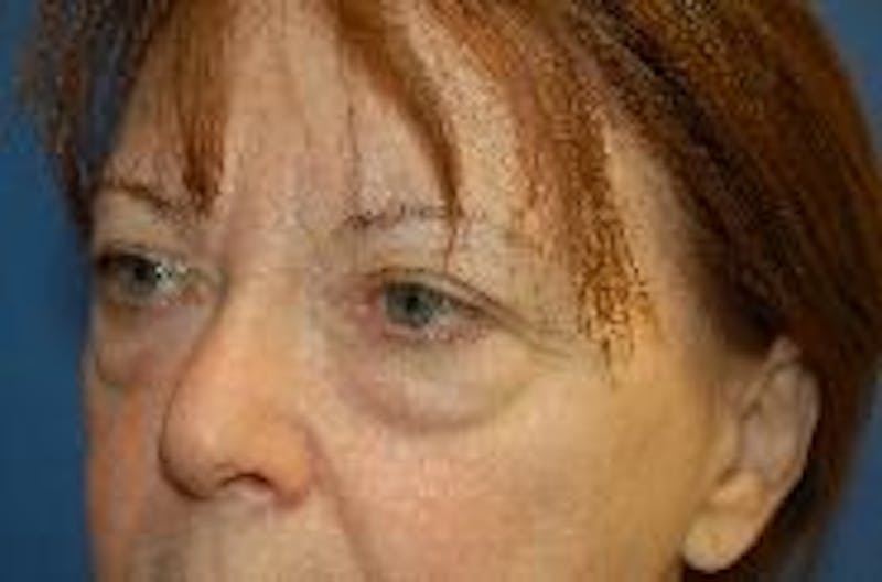 Eyelid Surgery Before & After Gallery - Patient 89990963 - Image 3