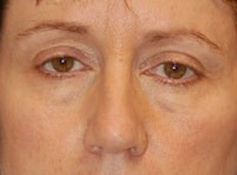 Eyelid Surgery Before & After Gallery - Patient 89990973 - Image 1