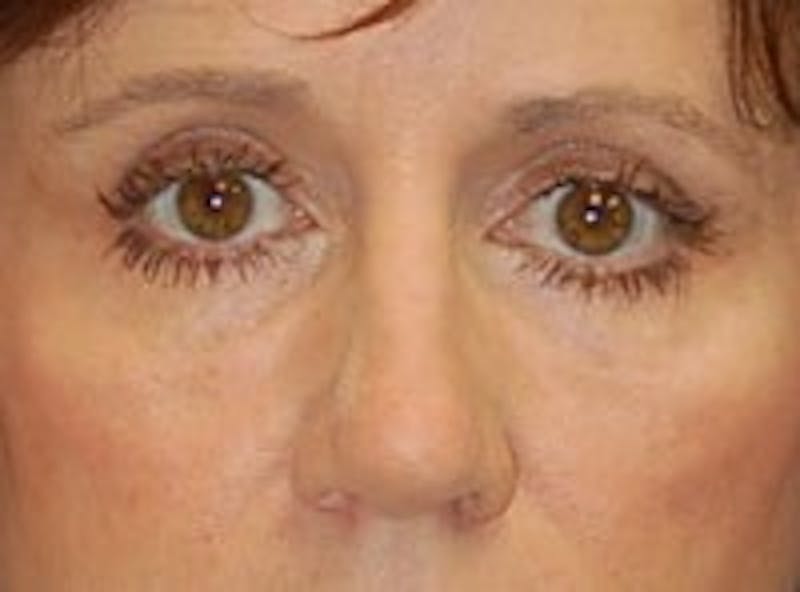 Eyelid Surgery Before & After Gallery - Patient 89990973 - Image 2