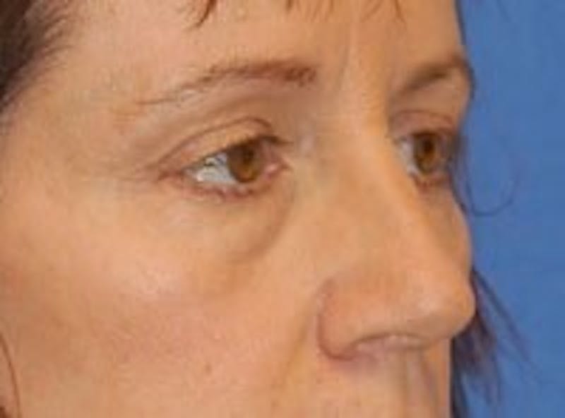 Eyelid Surgery Before & After Gallery - Patient 89990973 - Image 3