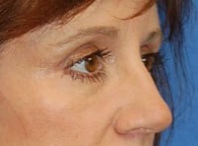 Eyelid Surgery Before & After Gallery - Patient 89990973 - Image 4