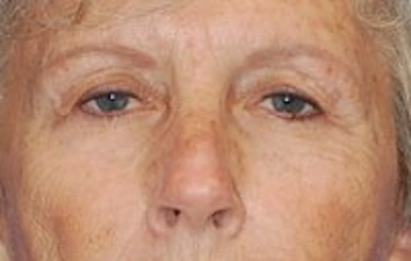 Eyelid Surgery Before & After Gallery - Patient 89990983 - Image 1