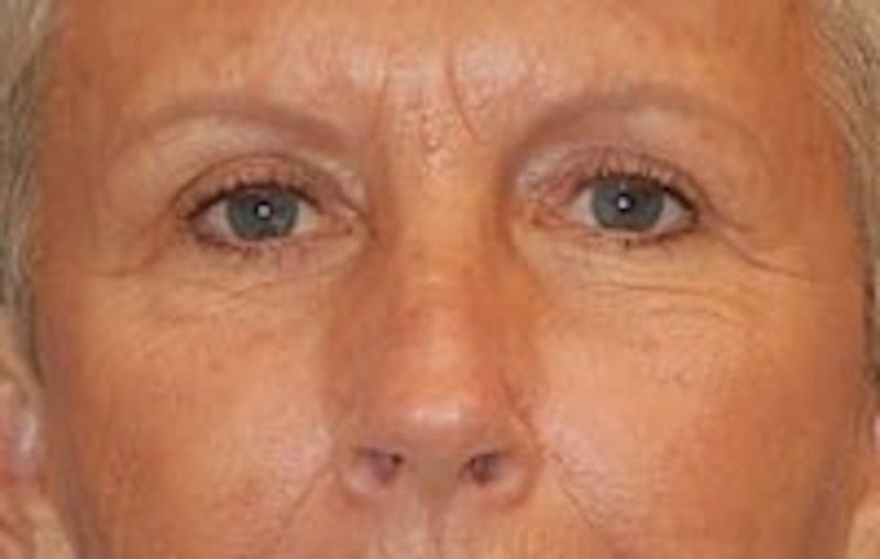 Eyelid Surgery Before & After Gallery - Patient 89990983 - Image 2