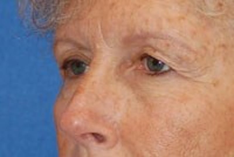 Eyelid Surgery Before & After Gallery - Patient 89990983 - Image 3