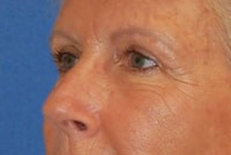 Eyelid Surgery Before & After Gallery - Patient 89990983 - Image 4